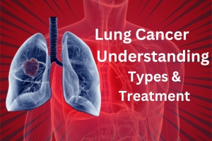 Lung Cancer Understanding Causes, Types, and Treatment