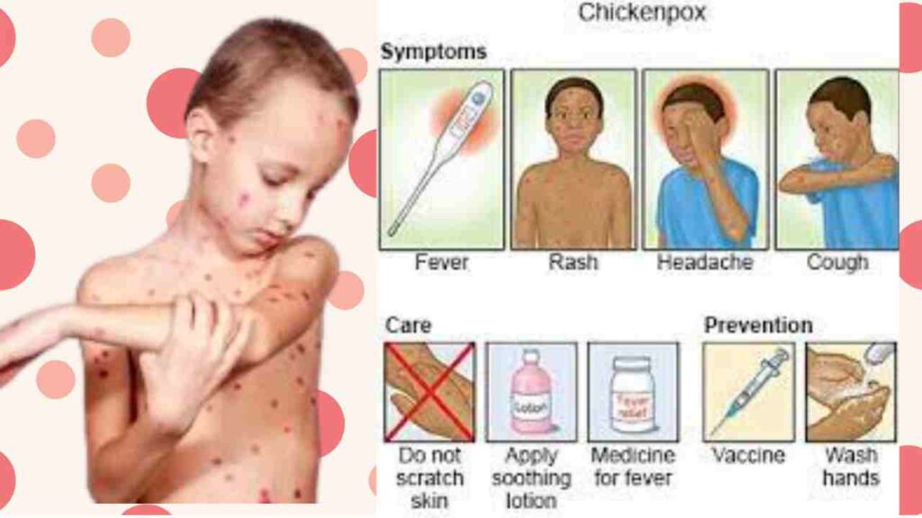 Prevention chickenpox
